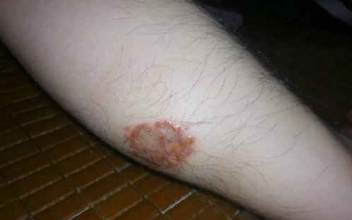 廚師小腿被蚊子叮潰爛 1年不愈合，竟是職業(yè)病引起的